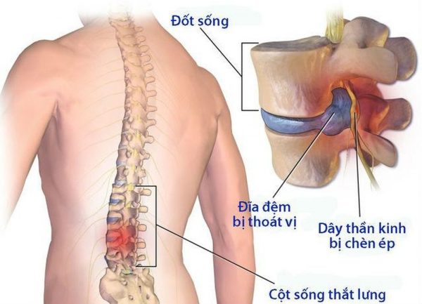 Đau ngang thắt lưng là bệnh gì?