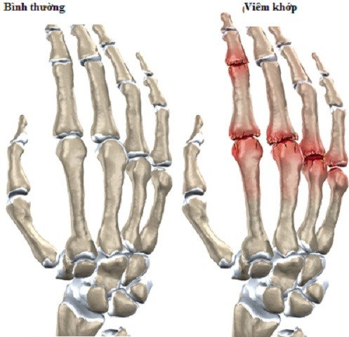 Đau nhức các đốt ngón tay là bệnh gì?