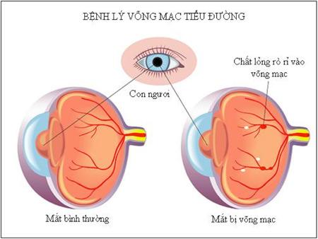 Đau nhức hốc mắt là biểu hiện của bệnh gì?