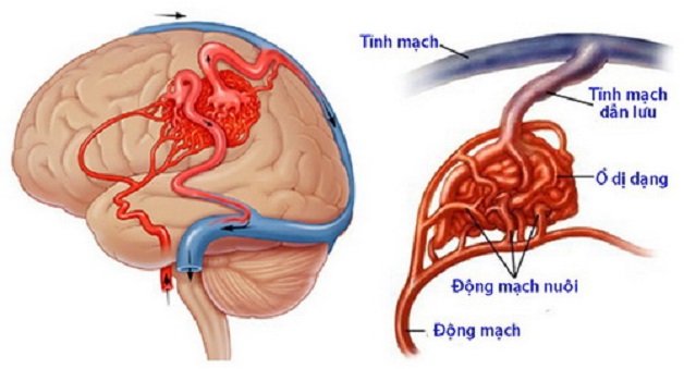 Đau nửa đầu đau tai là bệnh gì? Cách điều trị