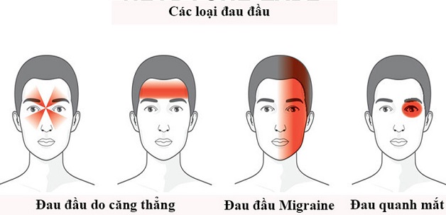 Đau nửa đầu nguyên nhân, cách xử trí, thực phẩm bổ sung