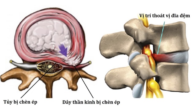 Đau nửa đầu sau và vai gáy là biểu hiện của bệnh gì?