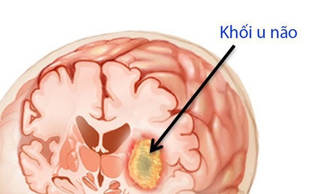 Đau nửa đầu thường xuyên cảnh báo bệnh gì?