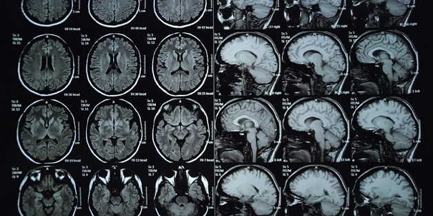 Đau nửa đầu thường xuyên có nên chụp MRI không?