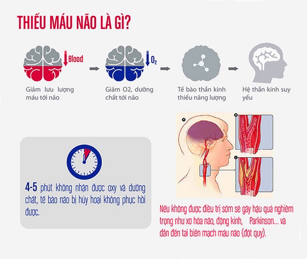 Đau nửa đầu trên: Nguyên nhân, biểu hiện, điều trị và phòng ngừa