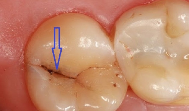 Đau răng số 7: các nguyên nhân và cách khắc phục