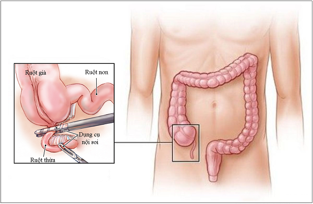 Đau ruột thừa bên nào – Góc giải đáp