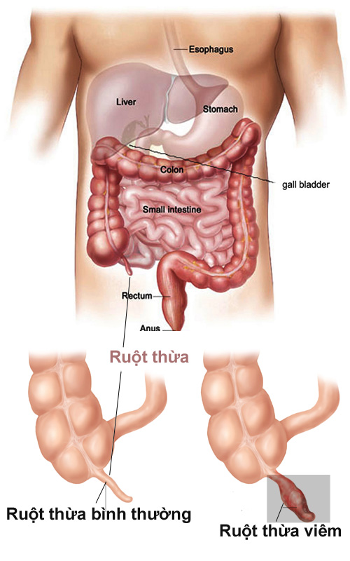 Đau ruột thừa bên nào? Triệu chứng và cách xử trí