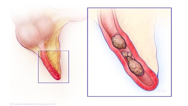 Đau ruột thừa ở trẻ em: Nhận biết và xử trí