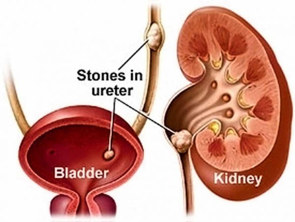 Đau sỏi thận là đau như thế nào? Các phương pháp điều trị