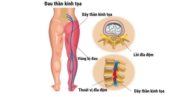 Đau thần kinh tọa là đau ở đâu? Có nguy hiểm không?