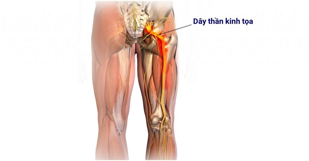 Đau thần kinh tọa và cách chữa trị hiệu quả nhất