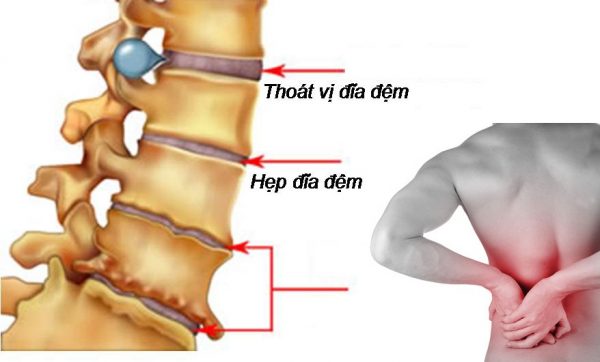 Đau thắt lưng là biểu hiện của bệnh gì?