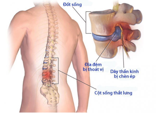 Đau thắt lưng ở nam giới tiềm ẩn nhiều bệnh lý nguy hiểm