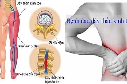 Đau thắt lưng ở nam giới tiềm ẩn nhiều bệnh lý nguy hiểm