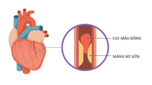 Đau tim là bệnh gì? xuất phát từ nhiều nguyên nhân khác nhau