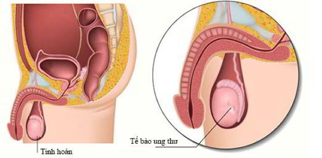 Đau tinh hoàn một bên: Dấu hiệu đáng báo động