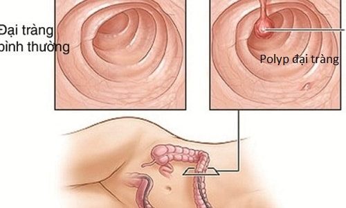 Đau trực tràng hậu môn có chữa được không?