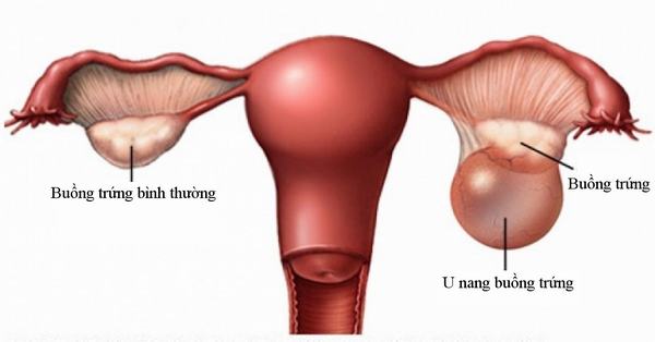 Đau vùng hạ vị – nguyên nhân do đâu?