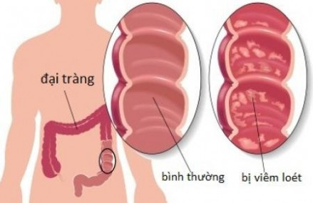 Đầy bụng đi ngoài phải làm sao?