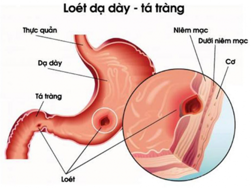 Đầy hơi chướng bụng nên làm gì?