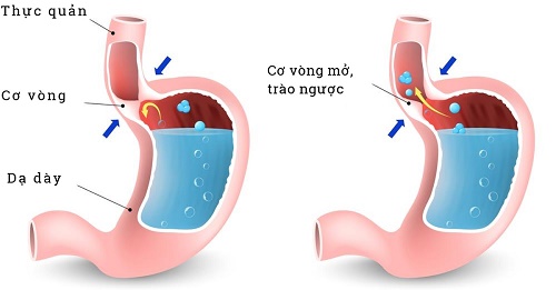 Đầy hơi có phải dấu hiệu mang thai?