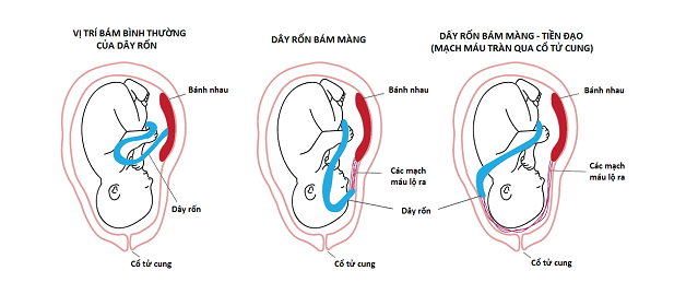 Dây rốn bám lệch tâm ảnh hưởng tới thai nhi như thế nào?