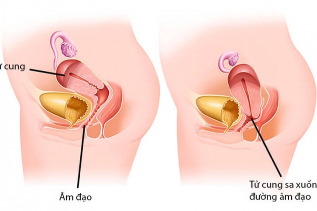 Đẻ mổ có bị sa tử cung không? Cách phòng tránh ra sao?