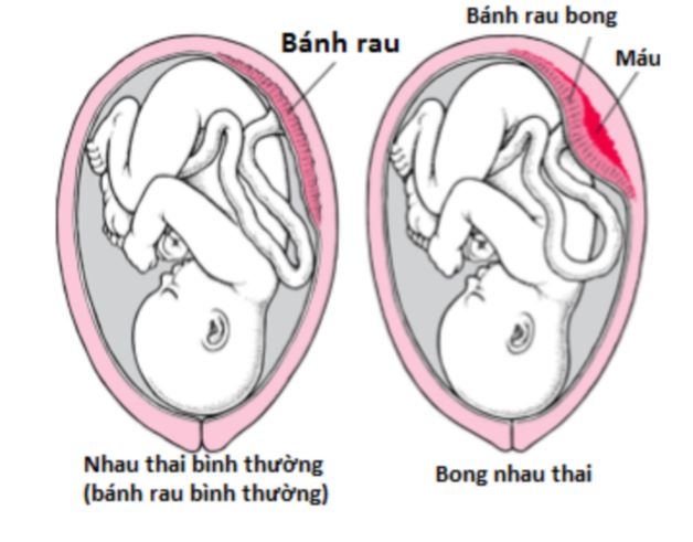 Đẻ mổ có bị sót rau không? Nguyên nhân và cách điều trị