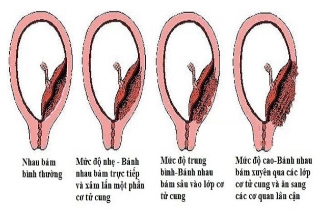 Đẻ mổ có bị sót rau không? Nguyên nhân và cách điều trị