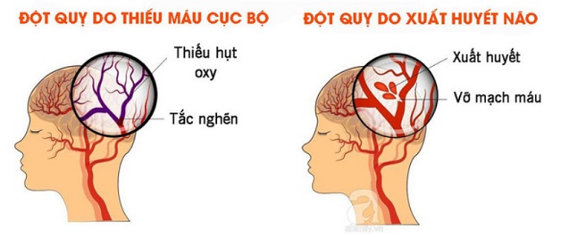 Đề phòng đột quỵ cấp gia tăng khi thời tiết lạnh