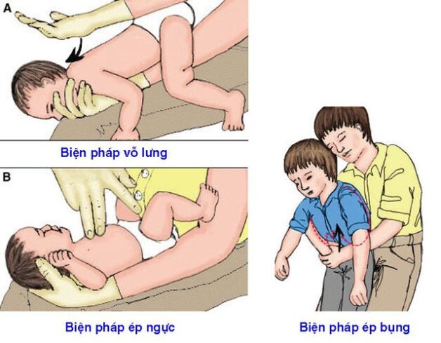 Đề phòng và xử lý người bị hóc dị vật đường thở đúng cách