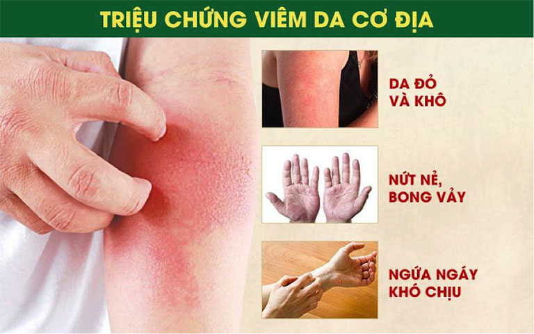 Đề phòng viêm da cơ địa khi thời tiết hanh khô