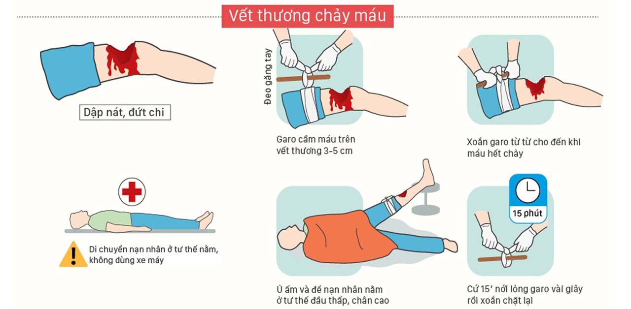 Để sơ cứu vết thương chảy máu hãy đọc ngay cách sau