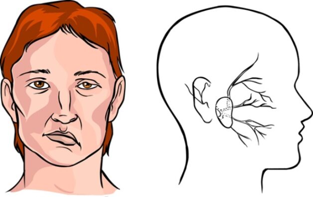 Di chứng có thể xảy ra sau cơn đột quỵ não