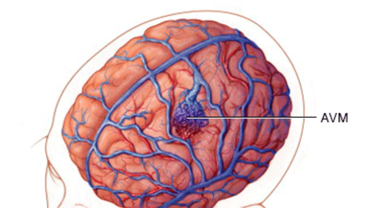 Dị dạng động tĩnh mạch não và vai trò của MRI trong chẩn đoán