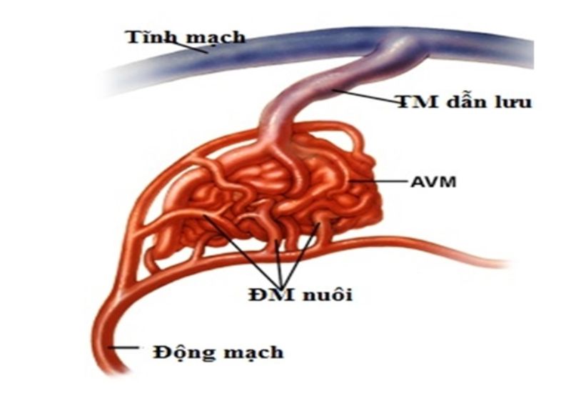 Dị dạng động tĩnh mạch não và vai trò của MRI trong chẩn đoán