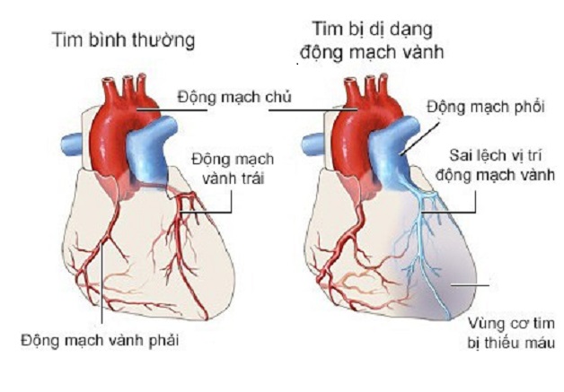 Dị dạng mạch vành là gì? Triệu chứng và cách điều trị 