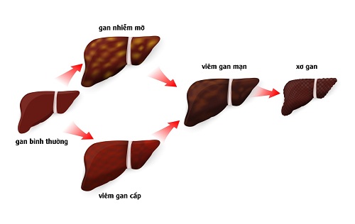 Đi tìm lời giải bệnh gan nhiễm mỡ có mấy cấp độ