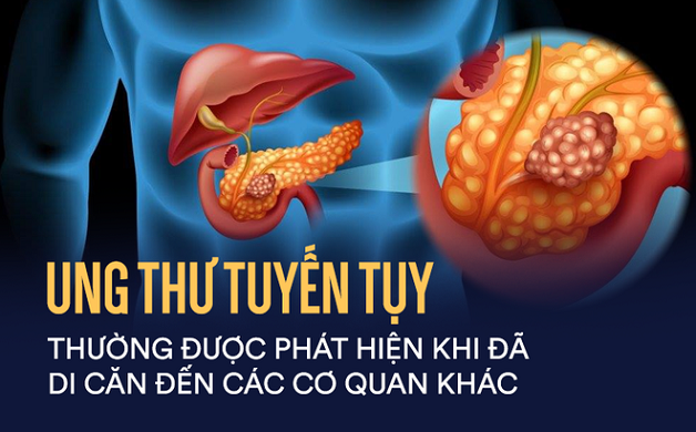 Đi tìm lời giải: Ung thư tụy là ung thư gì?