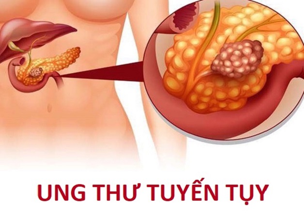 Đi tìm lời giải: Ung thư tụy là ung thư gì?