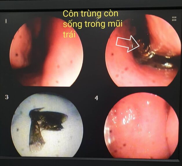 Dị vật bay vào mũi – Bình tĩnh để xử lý đúng cách