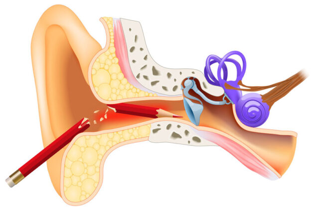 Dị vật chui vào tai – Xử lý sai, nhiều hệ lụy