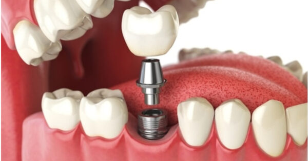 Địa chỉ cấy ghép Implant tốt và tiêu chí đánh giá