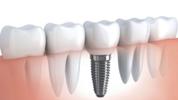 Địa chỉ cấy ghép Implant tốt và tiêu chí đánh giá