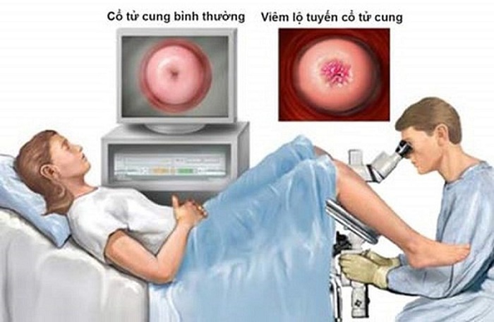 Địa chỉ chữa viêm lộ tuyến tốt ở Hà Nội