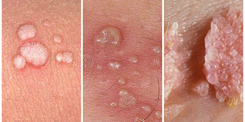 Địa chỉ tiêm phòng HPV an toàn và hiệu quả