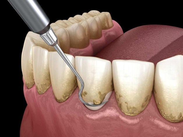 Địa chỉ uy tín lấy cao răng siêu âm ở Hà Nội