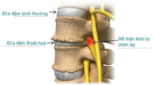 Đĩa đệm mất nước là bệnh gì?