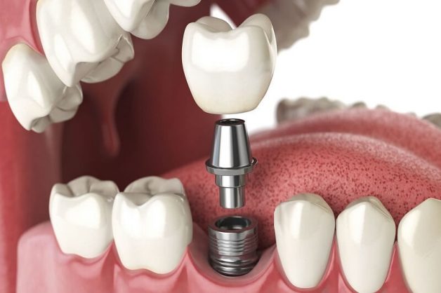 Địa điểm cấy ghép răng implant uy tín